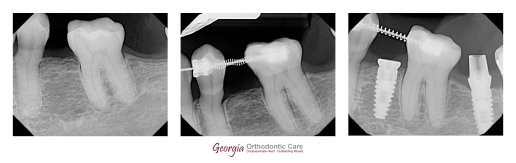 Missing teeth, dental implant, orthodontist, orthodontic treatment, Lawrenceville, Norcross, GA, Nguyen Orthodontics, Georgia Orthodontic 
Care