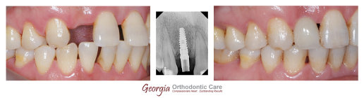 Missing teeth, dental implant, orthodontist, orthodontic treatment, Lawrenceville, Norcross, GA, Nguyen Orthodontics, Georgia Orthodontic 
Care