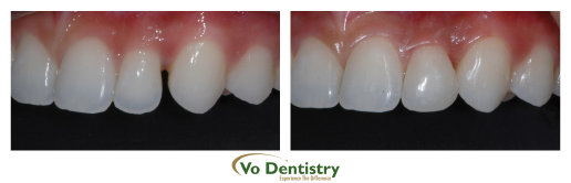 Orthodontic treatment, close spaces, composite, tooth colored, fillings, veneers,  orthodontist, cosmetic dentistry, Georgia Orthodontic 
Care, Vo Dentistry, Lawrenceville, Norcross, Lilburn, Dacula, buford, duluth, snellville, hamilton mill, grayson, sugar hill, sugar 
loaf, GA, Georgia, 30019, 30044, 30045